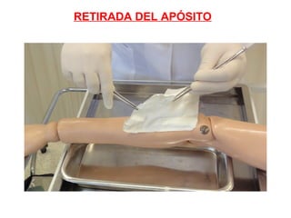 RETIRADA DEL APÓSITO
 