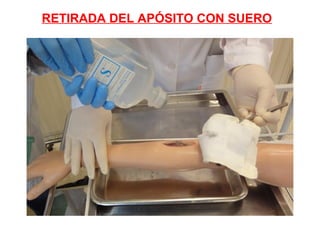 RETIRADA DEL APÓSITO CON SUERO
 