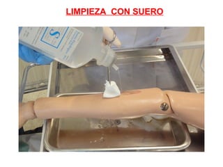 LIMPIEZA CON SUERO
 