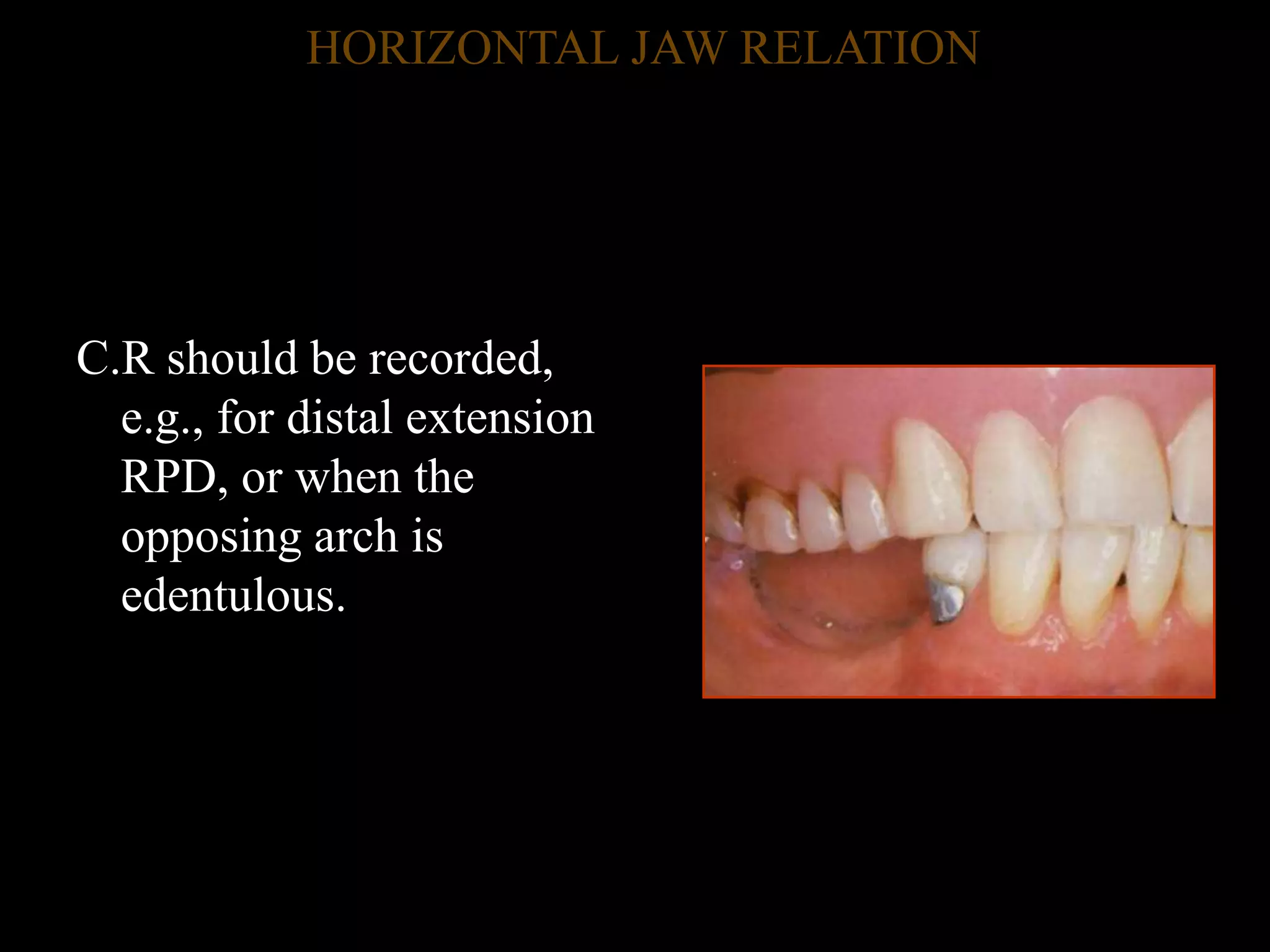3.jaw relation and occ in rpd | PPTX