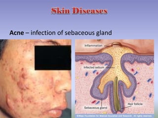 Acne – infection of sebaceous gland
 