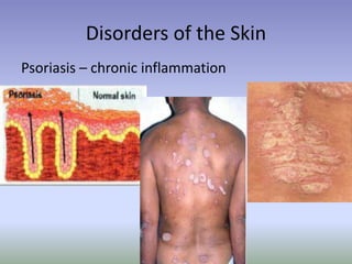 Disorders of the Skin
Psoriasis – chronic inflammation
 