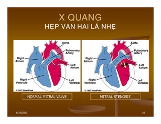 10
X QUANG
HEÏP VAN HAI LAÙ NHEÏ
NORMAL MITRAL VALVE MITRAL STENOSIS
6/19/2013
 