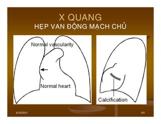 6/19/2013 101
X QUANG
HEÏP VAN ÑOÄNG MAÏCH CHUÛ
 