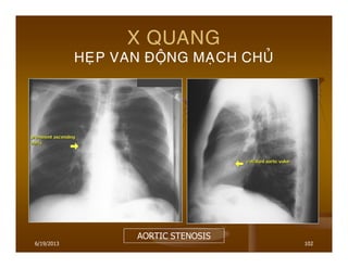 6/19/2013 102
X QUANG
HEÏP VAN ÑOÄNG MAÏCH CHUÛ
AORTIC STENOSIS
 