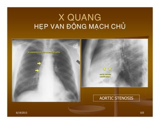 6/19/2013 103
X QUANG
HEÏP VAN ÑOÄNG MAÏCH CHUÛ
AORTIC STENOSIS
 
