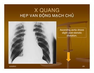 6/19/2013 105
X QUANG
HEÏP VAN ÑOÄNG MAÏCH CHUÛ
Ascending aorta shows
slight post-stenotic
dilatation.
 