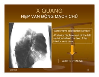 6/19/2013 106
X QUANG
HEÏP VAN ÑOÄNG MAÏCH CHUÛ
-Aortic valve calcification (arrow).
-Posterior displacement of the left
ventricle behind the line of the
inferior vena cava.
AORTIC STENOSIS
 