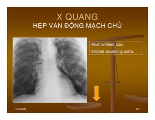 6/19/2013 107
X QUANG
HEÏP VAN ÑOÄNG MAÏCH CHUÛ
-Normal heart size.
-Dilated ascending aorta.
 