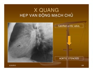 6/19/2013 108
X QUANG
HEÏP VAN ÑOÄNG MAÏCH CHUÛ
Calcified aortic valve.
AORTIC STENOSIS
 