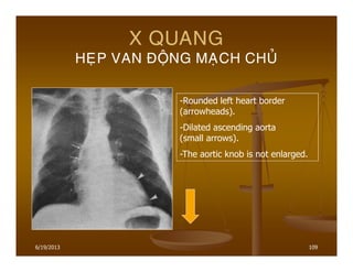 6/19/2013 109
X QUANG
HEÏP VAN ÑOÄNG MAÏCH CHUÛ
-Rounded left heart border
(arrowheads).
-Dilated ascending aorta
(small arrows).
-The aortic knob is not enlarged.
 