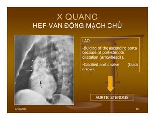 6/19/2013 110
X QUANG
HEÏP VAN ÑOÄNG MAÏCH CHUÛ
LAO
-Bulging of the ascending aorta
because of post-stenotic
dilatation (arrowheads).
-Calcified aortic valve (black
arrow).
AORTIC STENOSIS
 