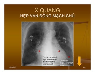 6/19/2013 111
X QUANG
HEÏP VAN ÑOÄNG MAÏCH CHUÛ
 