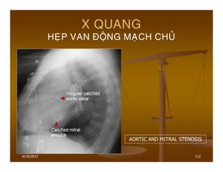 6/19/2013 112
X QUANG
HEÏP VAN ÑOÄNG MAÏCH CHUÛ
AORTIC AND MITRAL STENOSIS
 