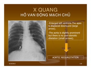 6/19/2013 118
X QUANG
HÔÛ VAN ÑOÄNG MAÏCH CHUÛ
-Enlarged left ventricle.The apex
is displaced downward (large
arrow).
-The aorta is slightly prominent
but there is no post-stenotic
dilatation (small arrows).
AORTIC REGURGITATION
 