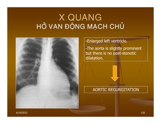 6/19/2013 120
X QUANG
HÔÛ VAN ÑOÄNG MAÏCH CHUÛ
-Enlarged left ventricle.
-The aorta is slightly prominent
but there is no post-stenotic
dilatation.
AORTIC REGURGITATION
 