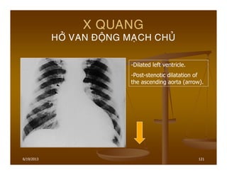 6/19/2013 121
X QUANG
HÔÛ VAN ÑOÄNG MAÏCH CHUÛ
-Dilated left ventricle.
-Post-stenotic dilatation of
the ascending aorta (arrow).
 
