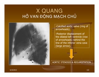 6/19/2013 122
X QUANG
HÔÛ VAN ÑOÄNG MAÏCH CHUÛ
-Calcified aortic valve (ring of
arrowheads).
-Posterior displacement of
the dilated left ventricle (row
of arrowheads) behind the
line of the inferior vena cava
(large arrow).
AORTIC STENOSIS & REGURGITATION
 
