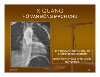 6/19/2013 123
X QUANG
HÔÛ VAN ÑOÄNG MAÏCH CHUÛ
RETROGRADE AORTOGRAM IN
AORTIC REGURGITATION
Reflux flow (arrows) in the dilated
left ventricle.
 