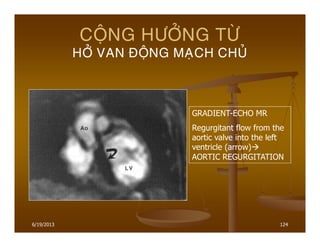 6/19/2013 124
COÄNG HÖÔÛNG TÖØ
HÔÛ VAN ÑOÄNG MAÏCH CHUÛ
GRADIENT-ECHO MR
Regurgitant flow from the
aortic valve into the left
ventricle (arrow)
AORTIC REGURGITATION
 
