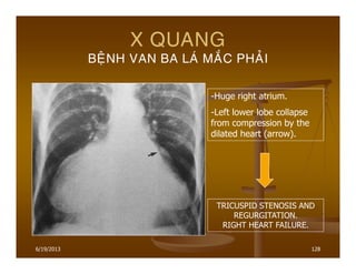 6/19/2013 128
X QUANG
BEÄNH VAN BA LAÙ MAÉC PHAÛI
-Huge right atrium.
-Left lower lobe collapse
from compression by the
dilated heart (arrow).
TRICUSPID STENOSIS AND
REGURGITATION.
RIGHT HEART FAILURE.
 