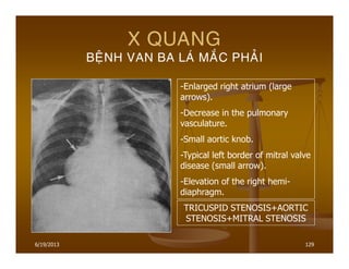 6/19/2013 129
X QUANG
BEÄNH VAN BA LAÙ MAÉC PHAÛI
-Enlarged right atrium (large
arrows).
-Decrease in the pulmonary
vasculature.
-Small aortic knob.
-Typical left border of mitral valve
disease (small arrow).
-Elevation of the right hemi-
diaphragm.
TRICUSPID STENOSIS+AORTIC
STENOSIS+MITRAL STENOSIS
 
