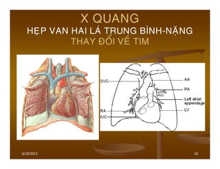 16
X QUANG
HEÏP VAN HAI LAÙ TRUNG BÌNH-NAËNG
THAY ÑOÅI VEÀ TIM
6/19/2013
 