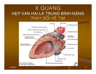 17
X QUANG
HEÏP VAN HAI LAÙ TRUNG BÌNH-NAËNG
THAY ÑOÅI VEÀ TIM
6/19/2013
 
