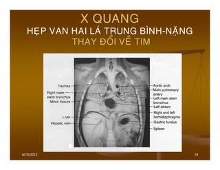 18
X QUANG
HEÏP VAN HAI LAÙ TRUNG BÌNH-NAËNG
THAY ÑOÅI VEÀ TIM
6/19/2013
 