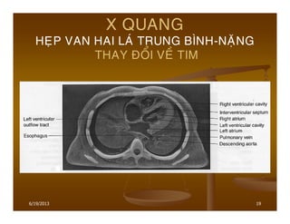 19
X QUANG
HEÏP VAN HAI LAÙ TRUNG BÌNH-NAËNG
THAY ÑOÅI VEÀ TIM
6/19/2013
 
