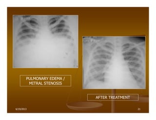 21
PULMONARY EDEMA /
MITRAL STENOSIS
AFTER TREATMENT
6/19/2013
 