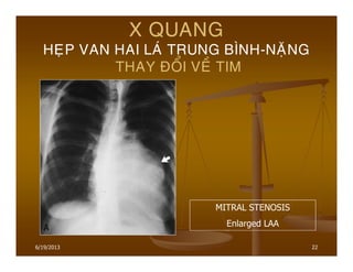 22
X QUANG
HEÏP VAN HAI LAÙ TRUNG BÌNH-NAËNG
THAY ÑOÅI VEÀ TIM
MITRAL STENOSIS
Enlarged LAA
6/19/2013
 