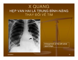23
X QUANG
HEÏP VAN HAI LAÙ TRUNG BÌNH-NAËNG
THAY ÑOÅI VEÀ TIM
Enlargement of the left atrial
appendage.
6/19/2013
 