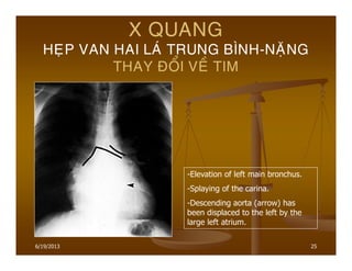 25
X QUANG
HEÏP VAN HAI LAÙ TRUNG BÌNH-NAËNG
THAY ÑOÅI VEÀ TIM
-Elevation of left main bronchus.
-Splaying of the carina.
-Descending aorta (arrow) has
been displaced to the left by the
large left atrium.
6/19/2013
 