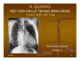 26
X QUANG
HEÏP VAN HAI LAÙ TRUNG BÌNH-NAËNG
THAY ÑOÅI VEÀ TIM
RAO-MITRAL STENOSIS
Enlarged LA
6/19/2013
 
