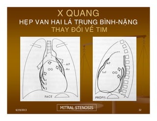6/19/2013 32
X QUANG
HEÏP VAN HAI LAÙ TRUNG BÌNH-NAËNG
THAY ÑOÅI VEÀ TIM
MITRAL STENOSIS
 