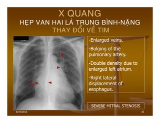 6/19/2013 33
X QUANG
HEÏP VAN HAI LAÙ TRUNG BÌNH-NAËNG
THAY ÑOÅI VEÀ TIM
-Enlarged veins.
-Bulging of the
pulmonary artery.
-Double density due to
enlarged left atrium.
-Right lateral
displacement of
esophagus.
SEVERE MITRAL STENOSIS
 
