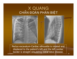 6/19/2013 34
X QUANG
CHAÅN ÑOAÙN PHAÂN BIEÄT
Pectus excavatum-Cardiac silhouette is rotated and
displaced to the patient’s left,and the left cardiac
border is straight simulating mitral valve disease.
 