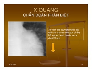 6/19/2013 35
X QUANG
CHAÅN ÑOAÙN PHAÂN BIEÄT
10-year-old asymptomatic boy
with an unusual contour of the
left upper heart border on a
chest X-ray.
 
