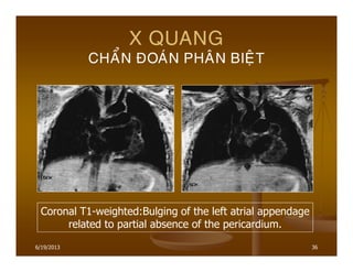 6/19/2013 36
X QUANG
CHAÅN ÑOAÙN PHAÂN BIEÄT
Coronal T1-weighted:Bulging of the left atrial appendage
related to partial absence of the pericardium.
 