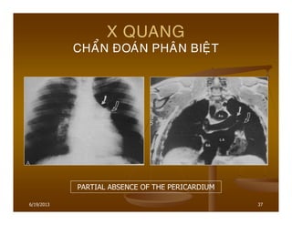 6/19/2013 37
X QUANG
CHAÅN ÑOAÙN PHAÂN BIEÄT
PARTIAL ABSENCE OF THE PERICARDIUM
 