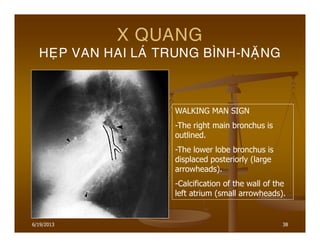 6/19/2013 38
X QUANG
HEÏP VAN HAI LAÙ TRUNG BÌNH-NAËNG
WALKING MAN SIGN
-The right main bronchus is
outlined.
-The lower lobe bronchus is
displaced posteriorly (large
arrowheads).
-Calcification of the wall of the
left atrium (small arrowheads).
 