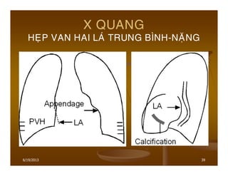 6/19/2013 39
X QUANG
HEÏP VAN HAI LAÙ TRUNG BÌNH-NAËNG
 