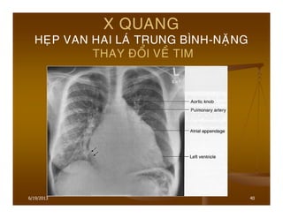 6/19/2013 40
X QUANG
HEÏP VAN HAI LAÙ TRUNG BÌNH-NAËNG
THAY ÑOÅI VEÀ TIM
 