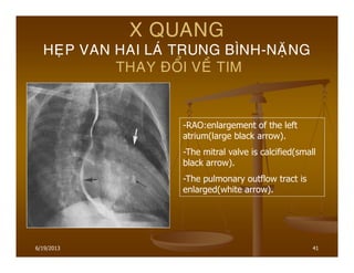 6/19/2013 41
X QUANG
HEÏP VAN HAI LAÙ TRUNG BÌNH-NAËNG
THAY ÑOÅI VEÀ TIM
-RAO:enlargement of the left
atrium(large black arrow).
-The mitral valve is calcified(small
black arrow).
-The pulmonary outflow tract is
enlarged(white arrow).
 