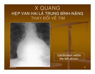 6/19/2013 43
X QUANG
HEÏP VAN HAI LAÙ TRUNG BÌNH-NAËNG
THAY ÑOÅI VEÀ TIM
Calcification within
the left atrium.
 