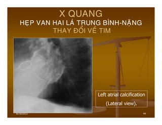 6/19/2013 44
X QUANG
HEÏP VAN HAI LAÙ TRUNG BÌNH-NAËNG
THAY ÑOÅI VEÀ TIM
Left atrial calcification
(Lateral view).
 