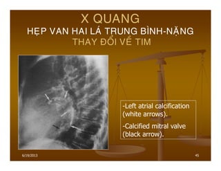 6/19/2013 45
X QUANG
HEÏP VAN HAI LAÙ TRUNG BÌNH-NAËNG
THAY ÑOÅI VEÀ TIM
-Left atrial calcification
(white arrows).
-Calcified mitral valve
(black arrow).
 