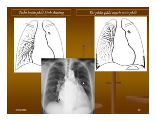 50
Tuần hoàn phổi bình thường Tái phân phối mạch máu phổi
6/19/2013
 