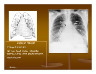 53
CARDIAC FAILURE
-Enlarged heart size.
-No clear heart border (interstitiel
edema), Kerley’s line, pleural effusion.
-Redistribution.
6/19/2013
 